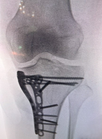 Tibial plato kırığı — lateral locking plate röntgen
